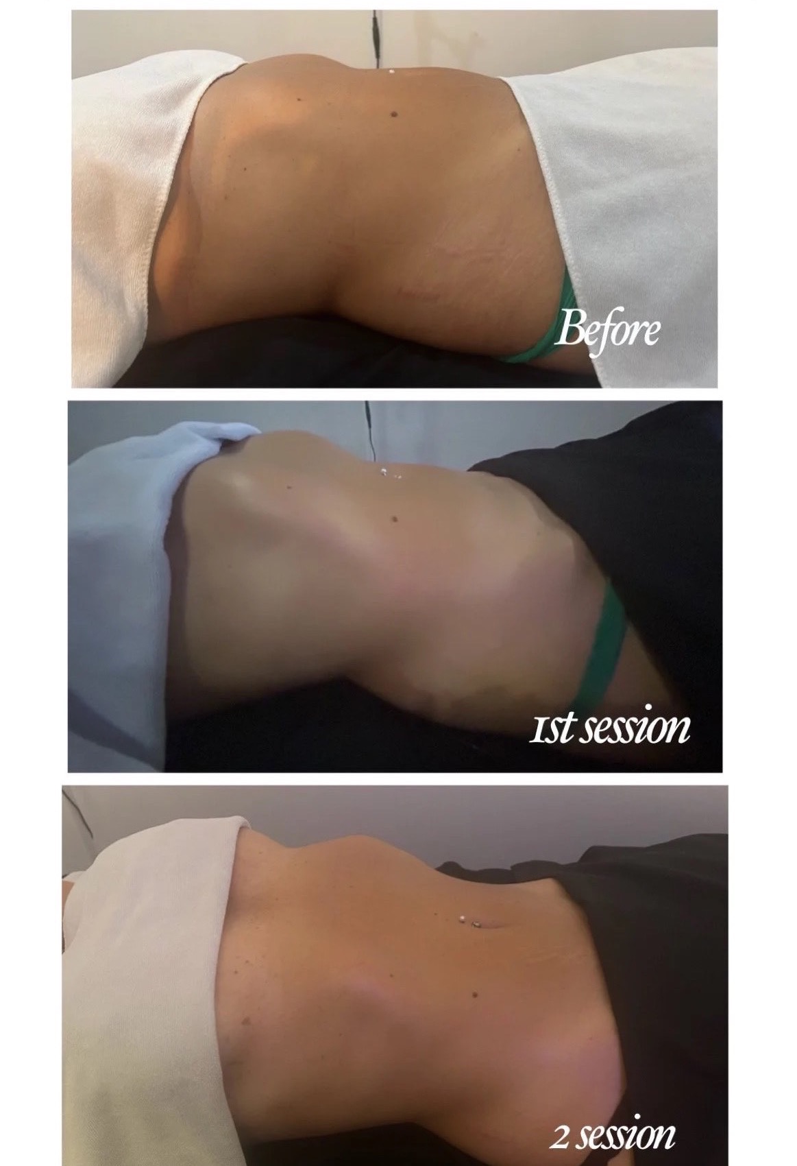 Before and after lymphatic drainage results — Before, 1st session, 2nd session